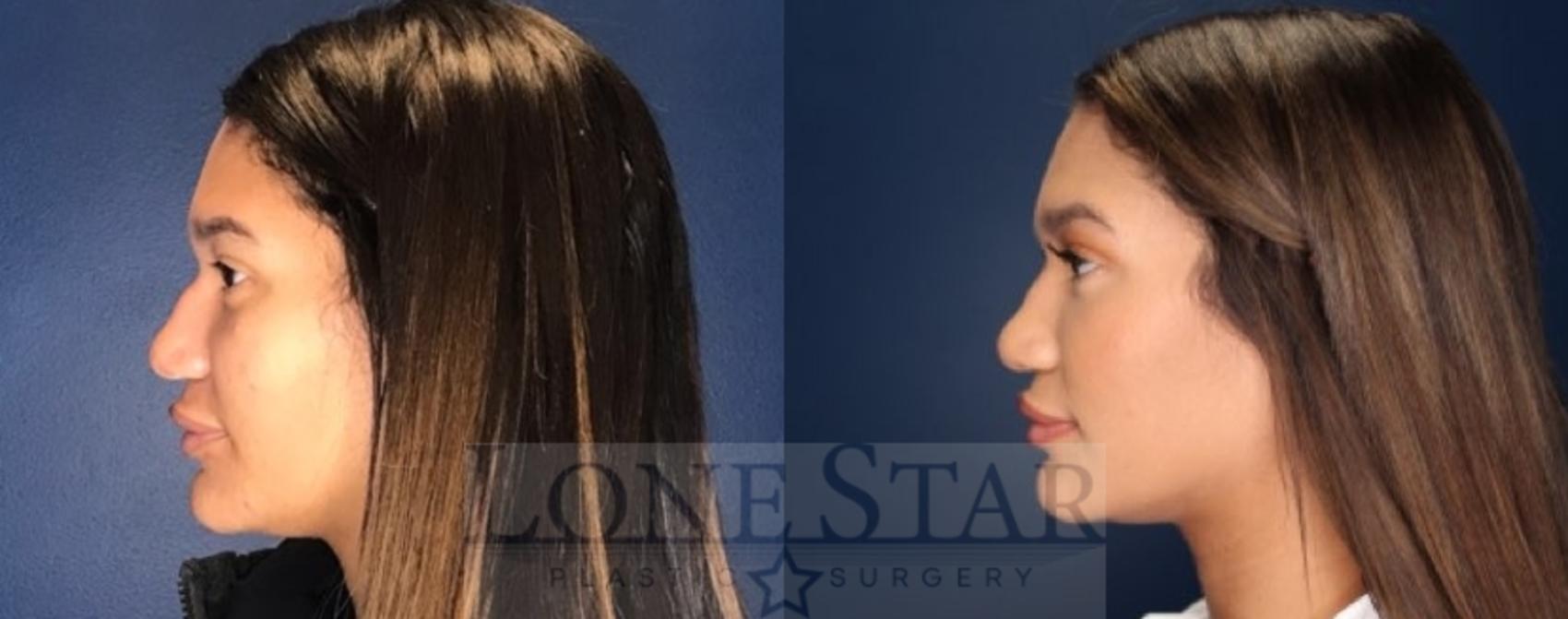 Before & After Rhinoplasty Case 85 Left Side View in Frisco, TX