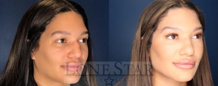 Before & After Rhinoplasty Case 85 Right Oblique View in Frisco, TX
