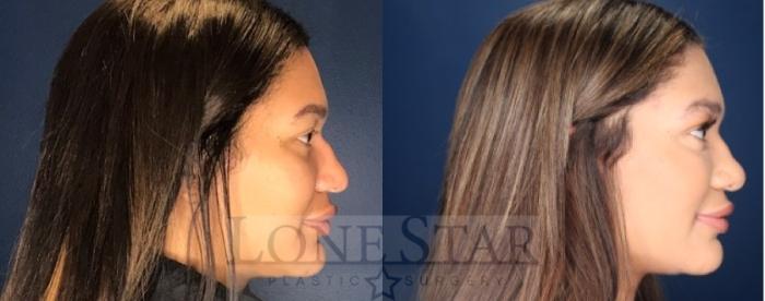 Before & After Rhinoplasty Case 85 Right Side View in Frisco, TX