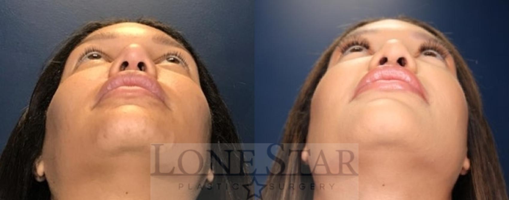 Before & After Rhinoplasty Case 85 Worm's Eye View in Frisco, TX