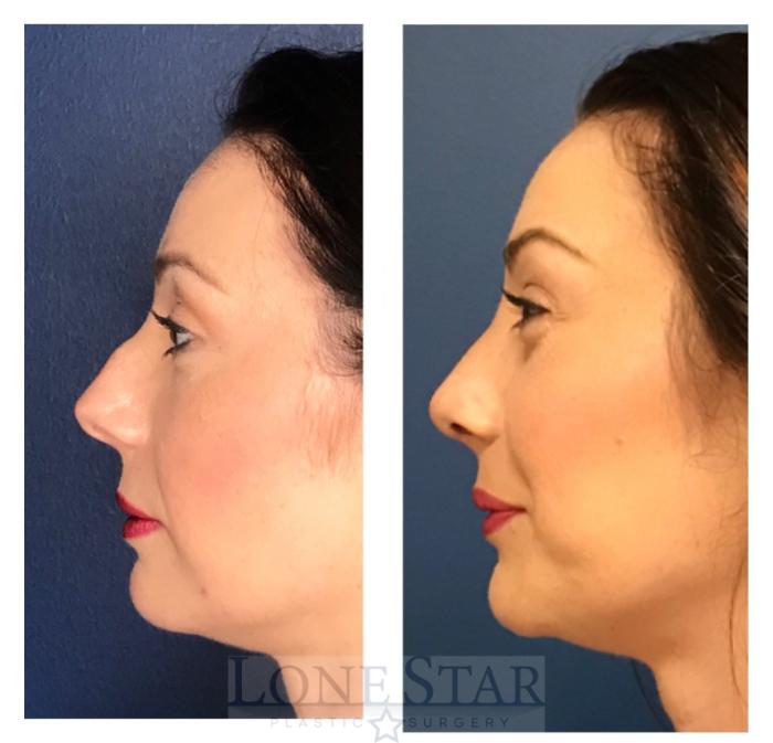 Before & After Rhinoplasty Case 9 View #1 View in Frisco, TX