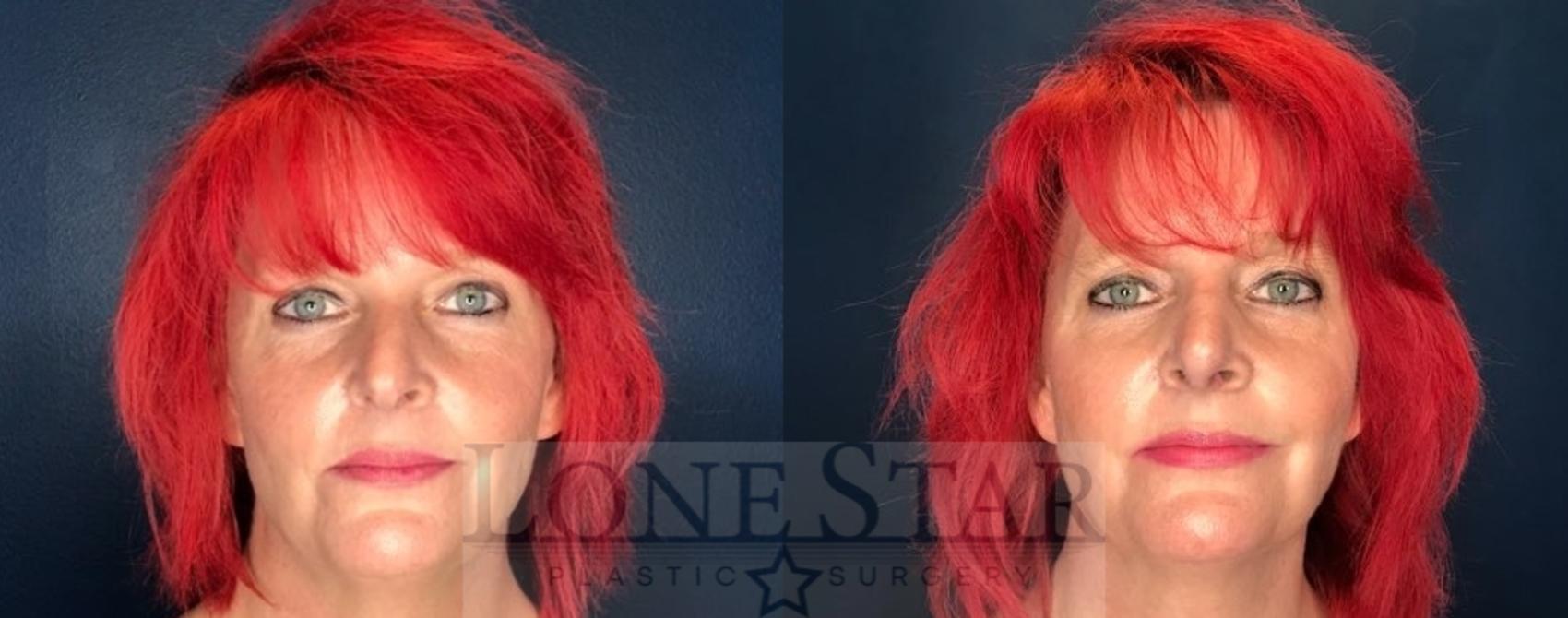 Before & After Rhinoplasty Case 90 Front View in Frisco, TX