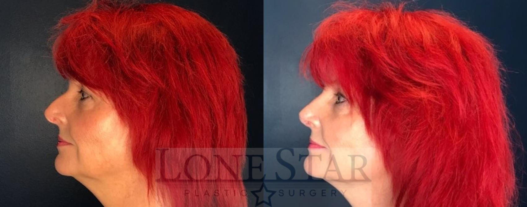 Before & After Rhinoplasty Case 90 Left Side View in Frisco, TX