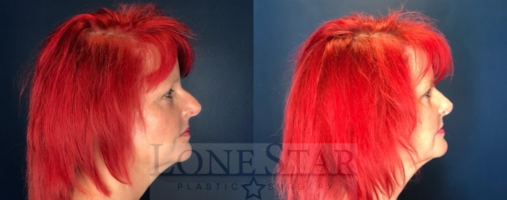 Before & After Rhinoplasty Case 90 Right Side View in Frisco, TX
