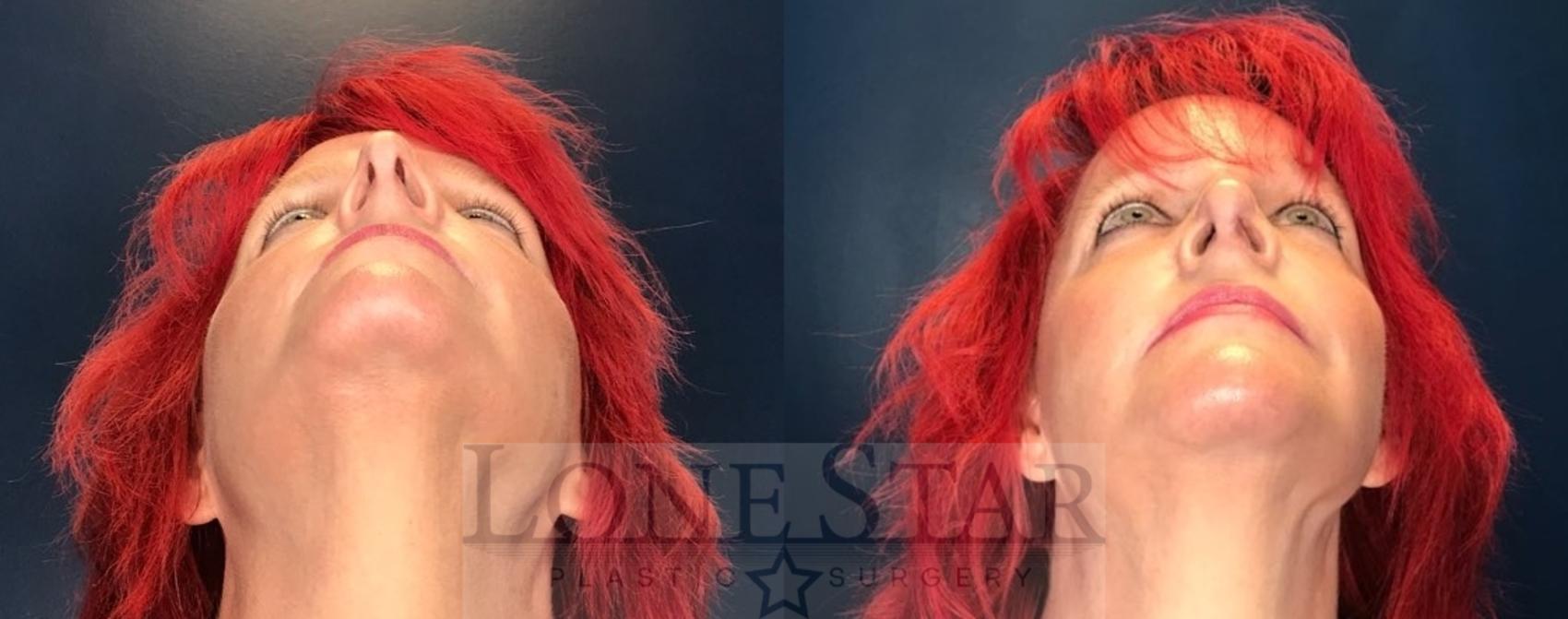 Before & After Rhinoplasty Case 90 Worm's-eye View in Frisco, TX