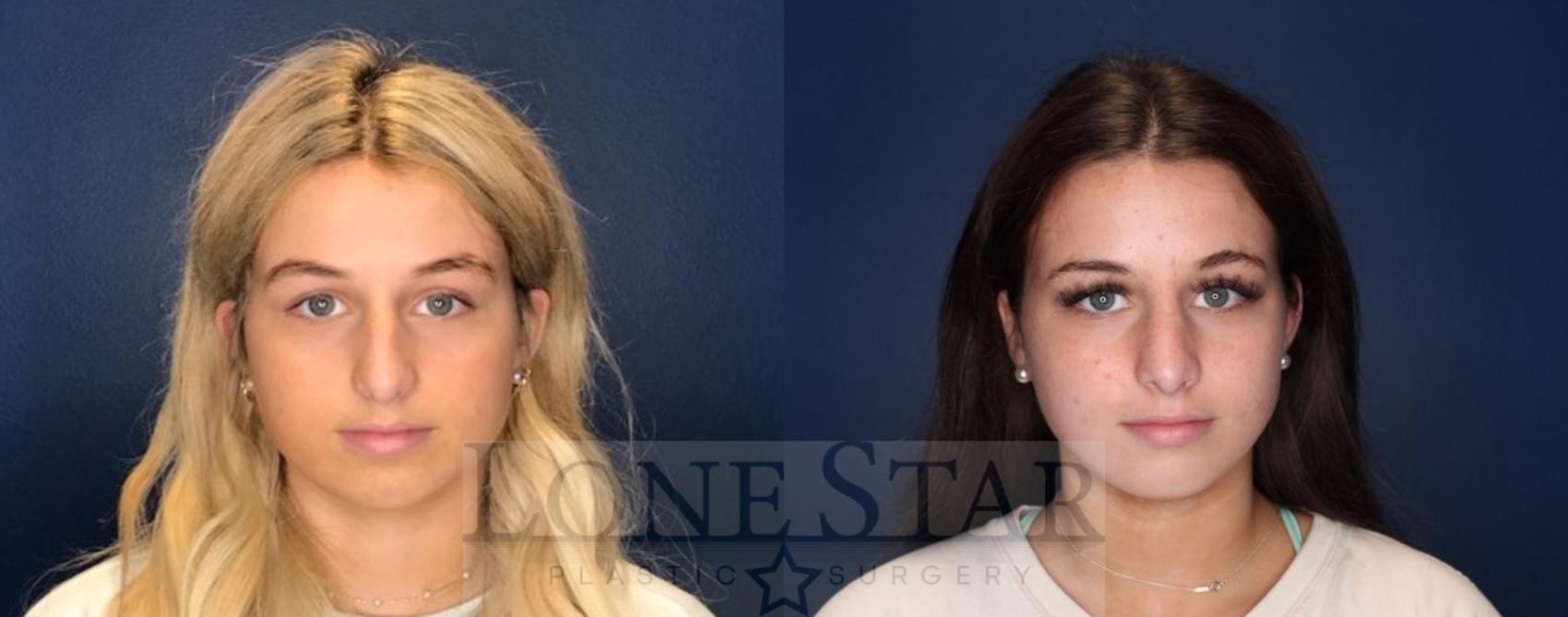 Before & After Rhinoplasty Case 94 Front View in Frisco, TX