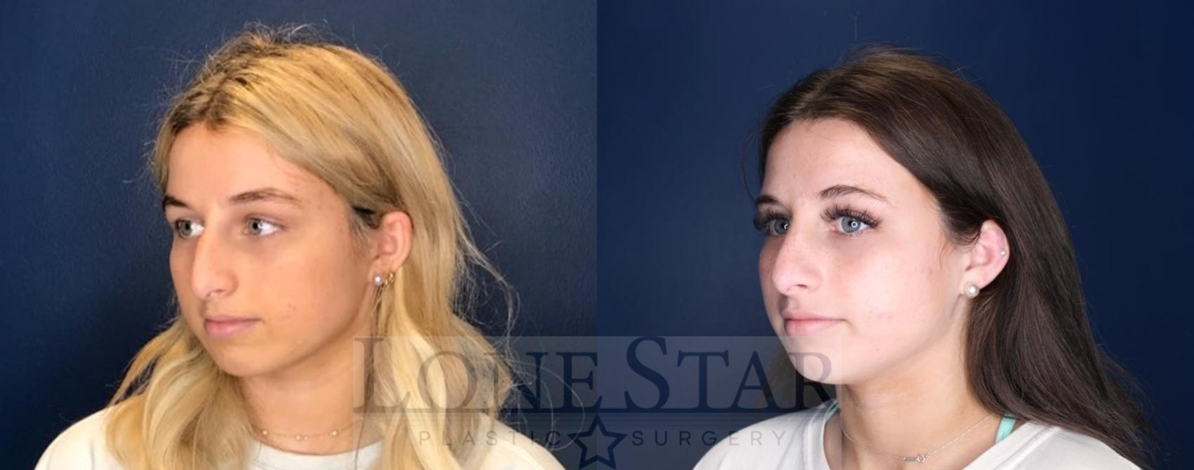 Before & After Rhinoplasty Case 94 Left Oblique View in Frisco, TX