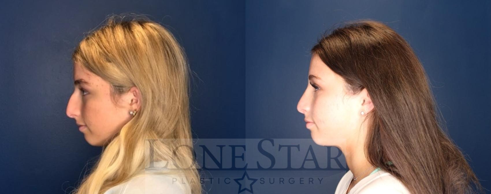 Before & After Rhinoplasty Case 94 Left Side View in Frisco, TX