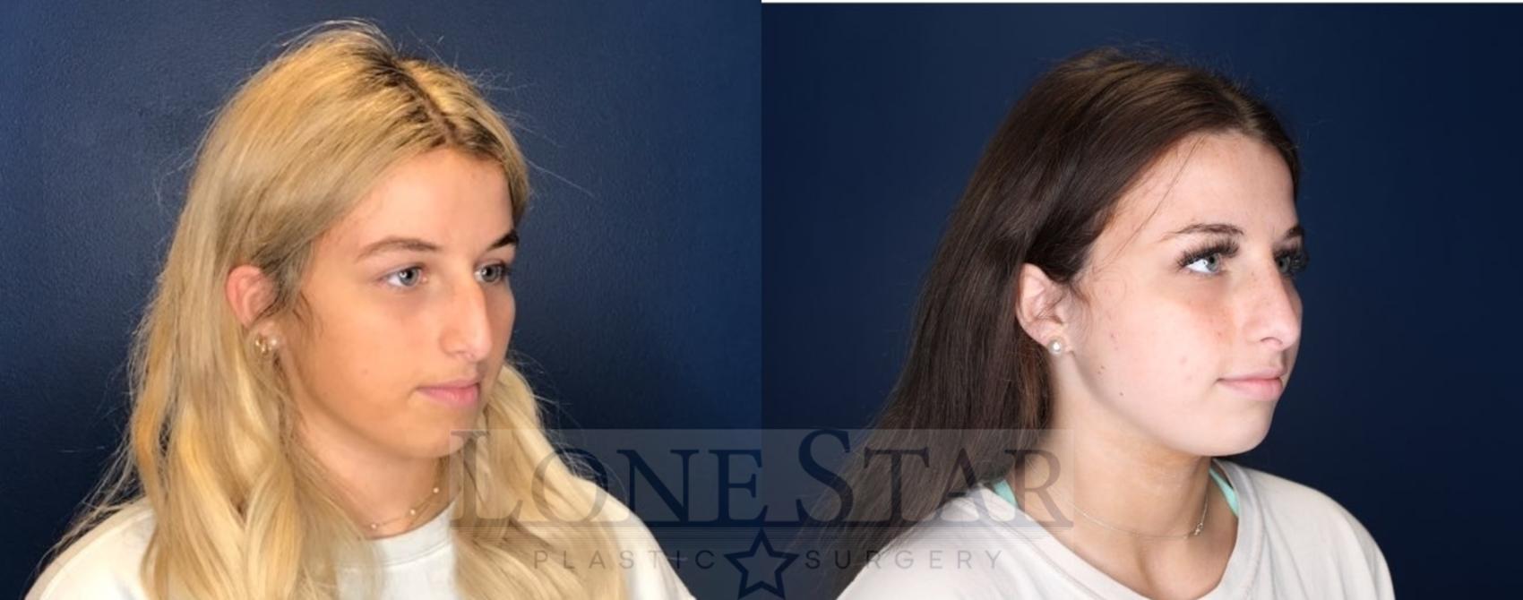 Before & After Rhinoplasty Case 94 Right Oblique View in Frisco, TX