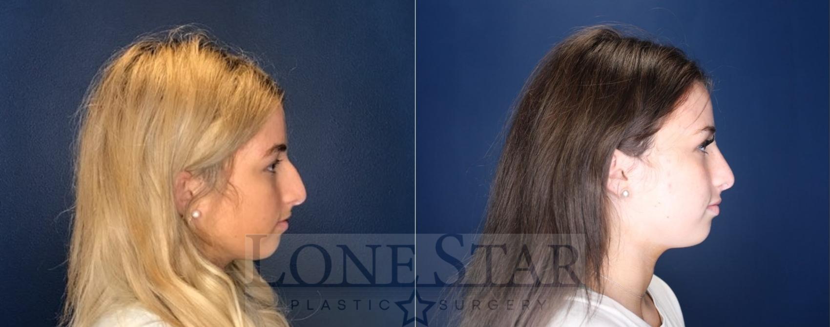 Before & After Rhinoplasty Case 94 Right Side View in Frisco, TX