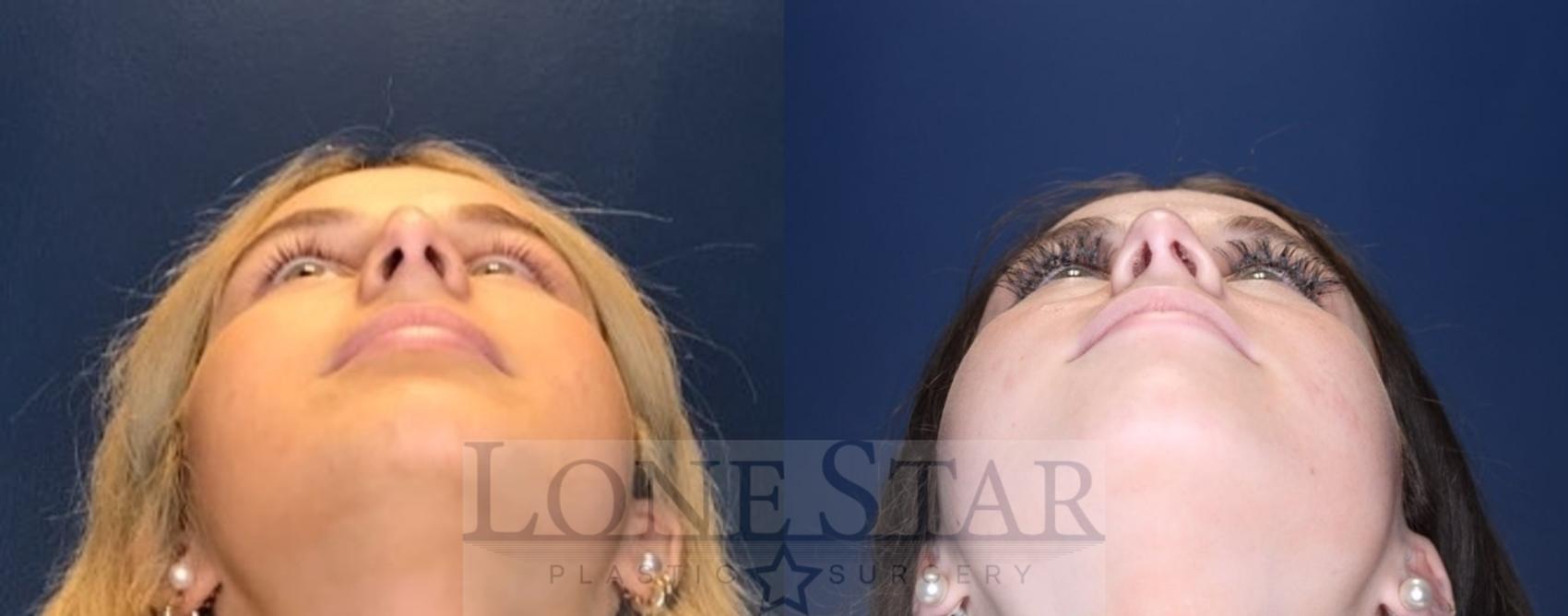 Before & After Rhinoplasty Case 94 Worm's-eye View in Frisco, TX