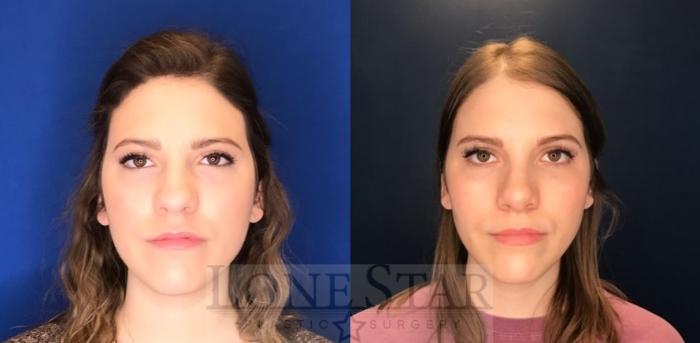 Before & After Rhinoplasty Case 96 Front View in Frisco, TX