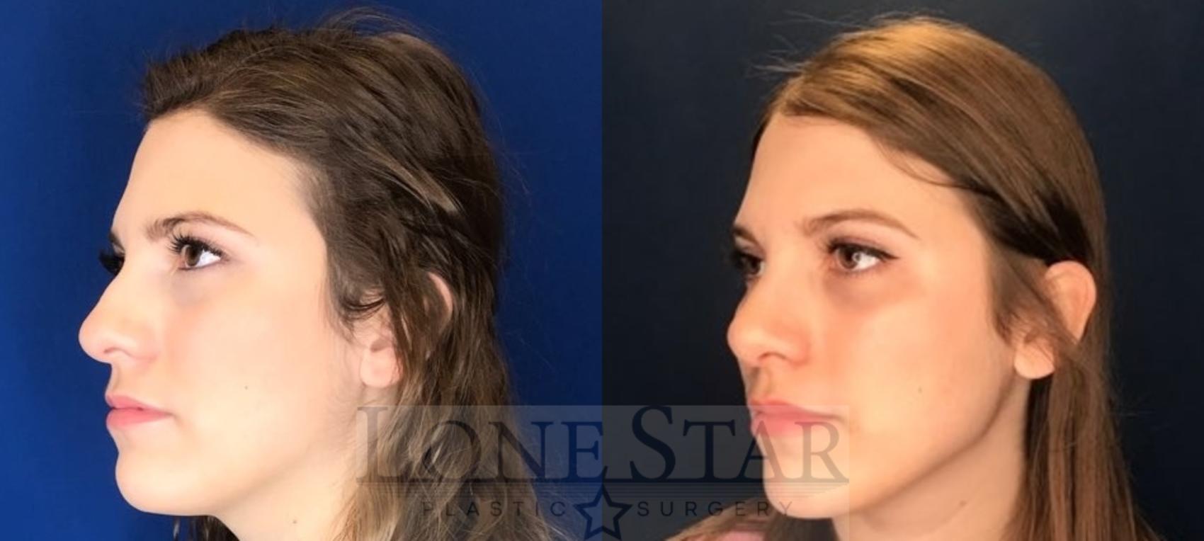 Before & After Rhinoplasty Case 96 Left Oblique View in Frisco, TX
