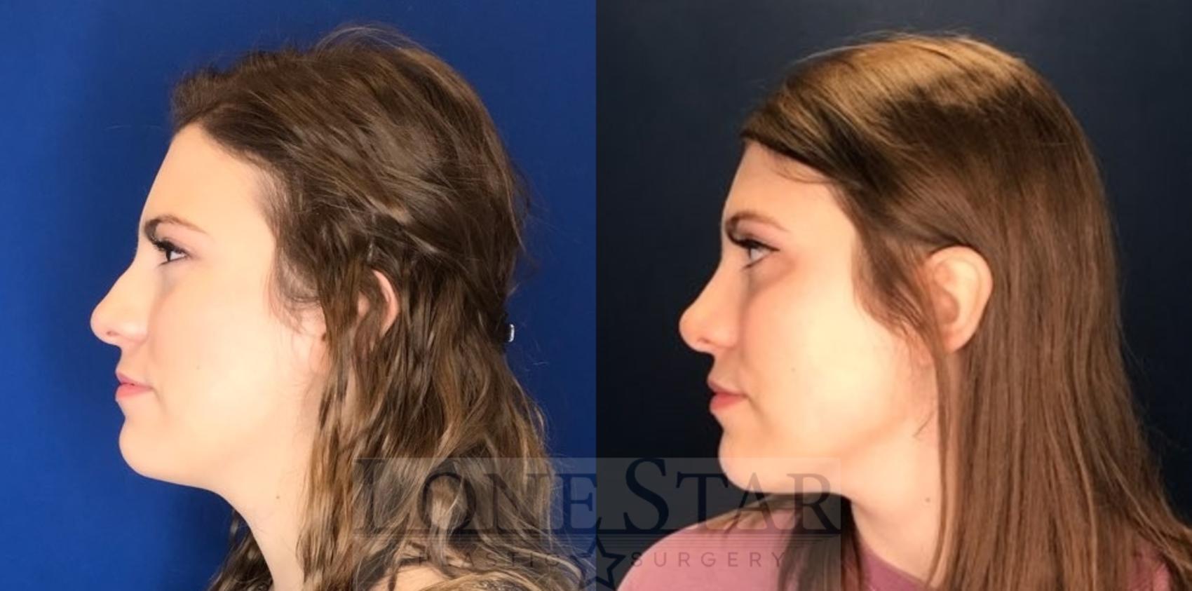 Before & After Rhinoplasty Case 96 Left Side View in Frisco, TX