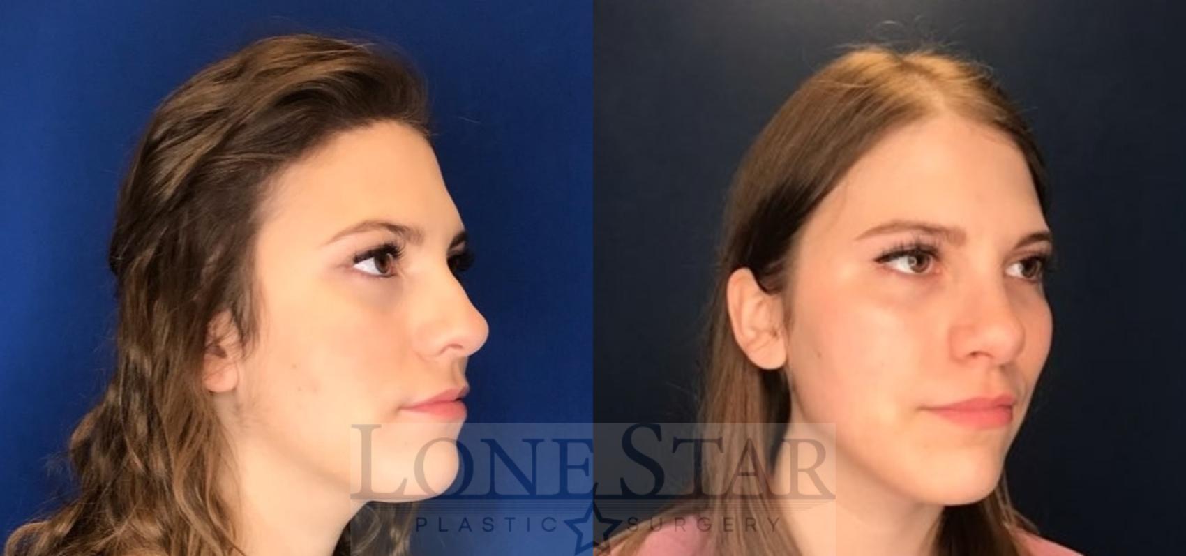 Before & After Rhinoplasty Case 96 Right Oblique View in Frisco, TX