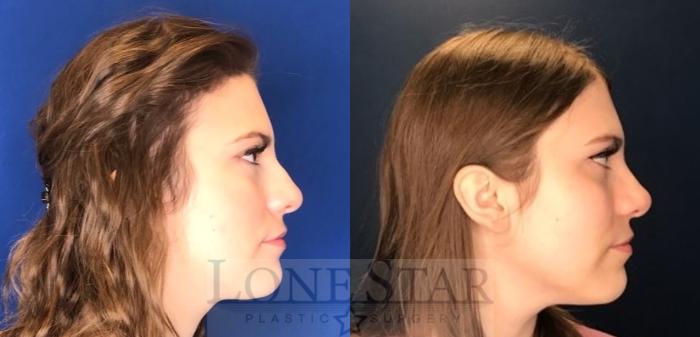 Before & After Rhinoplasty Case 96 Right Side View in Frisco, TX