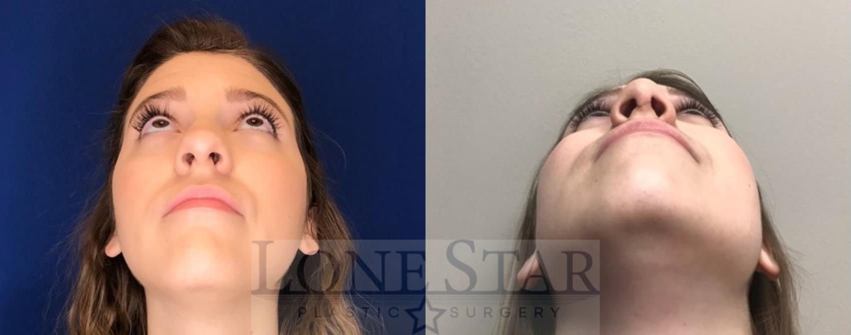 Before & After Rhinoplasty Case 96 Worm's-eye View in Frisco, TX