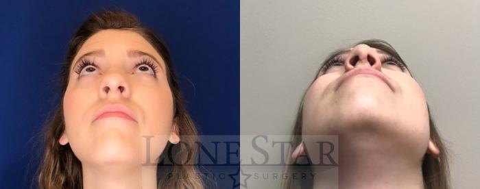Before & After Rhinoplasty Case 96 Worm's-eye View in Frisco, TX