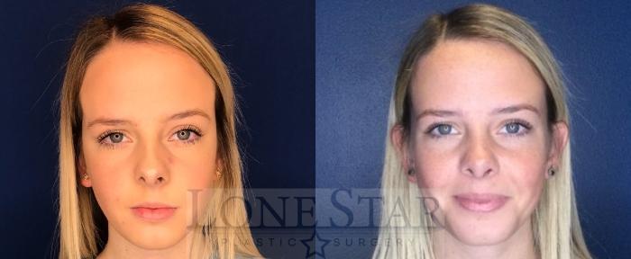 Before & After Rhinoplasty Case 97 Front View in Frisco, TX