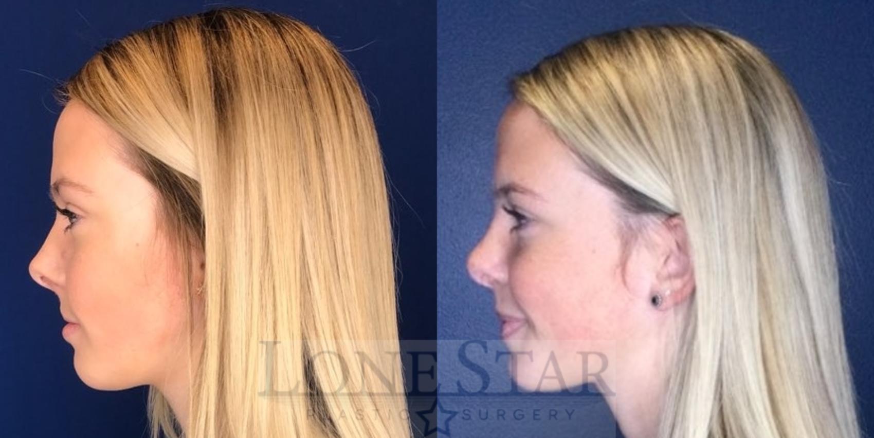 Before & After Rhinoplasty Case 97 Left Side View in Frisco, TX