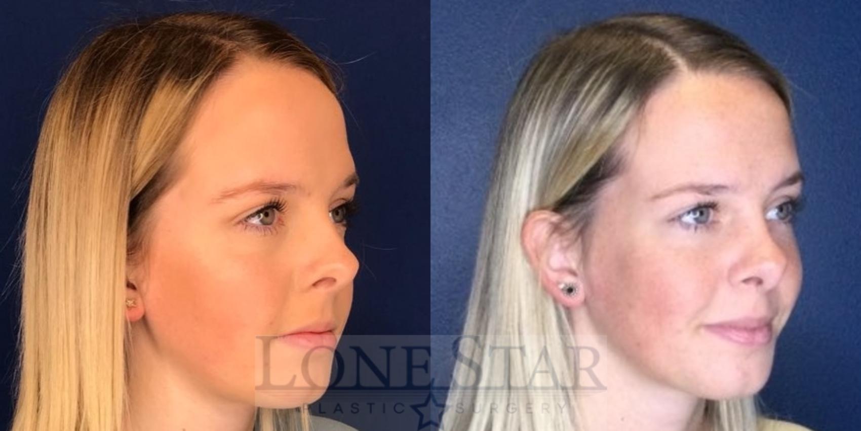 Before & After Rhinoplasty Case 97 Right Oblique View in Frisco, TX