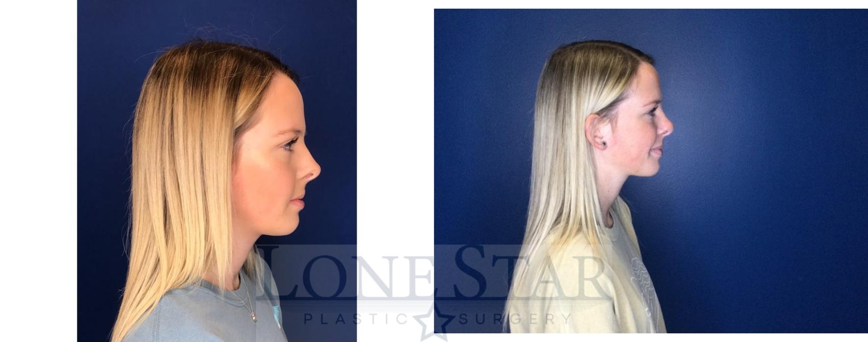 Before & After Rhinoplasty Case 97 Right Side View in Frisco, TX