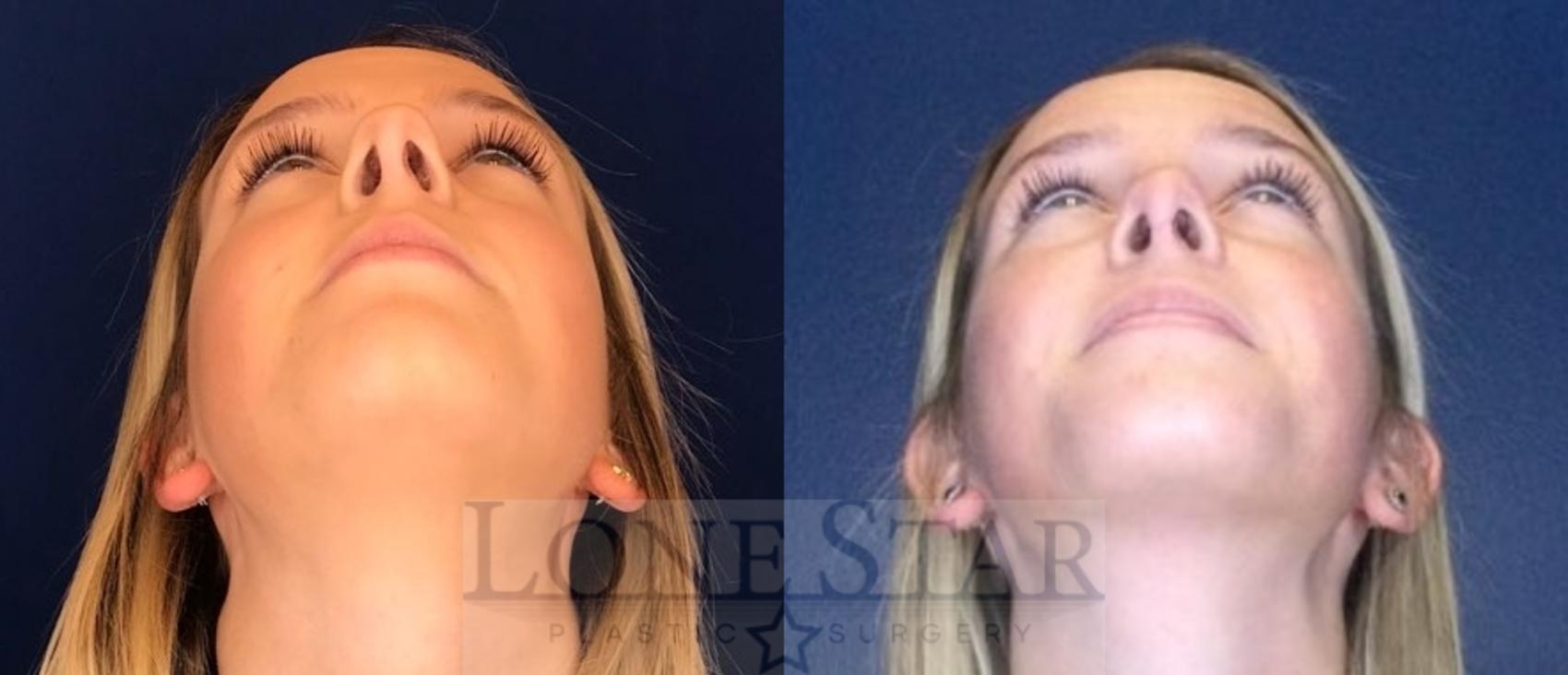 Before & After Rhinoplasty Case 97 Worm's-eye View in Frisco, TX