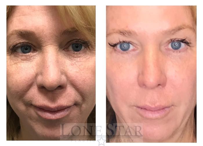 Before & After Skin Care / Chemical Peels Case 27 View #1 View in Frisco, TX