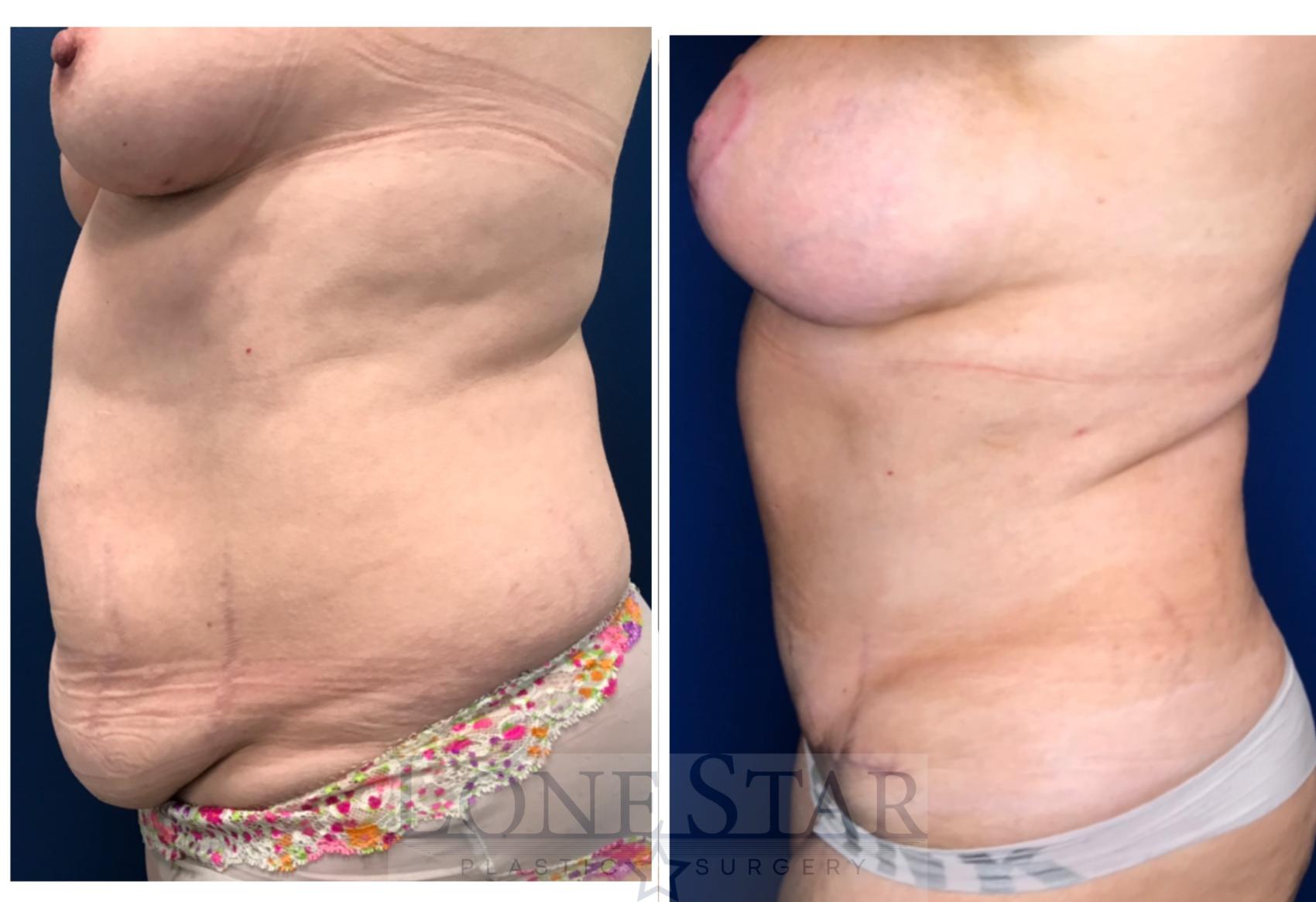 Before & After Tummy Tuck Case 10 View #1 View in Frisco, TX