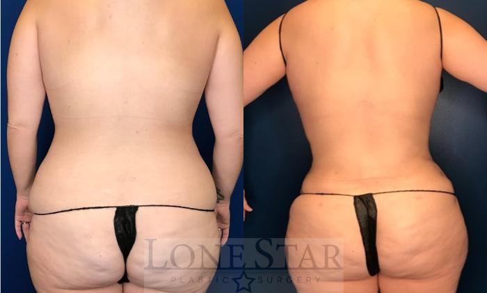 Before & After Tummy Tuck Case 105 Back View in Frisco, TX