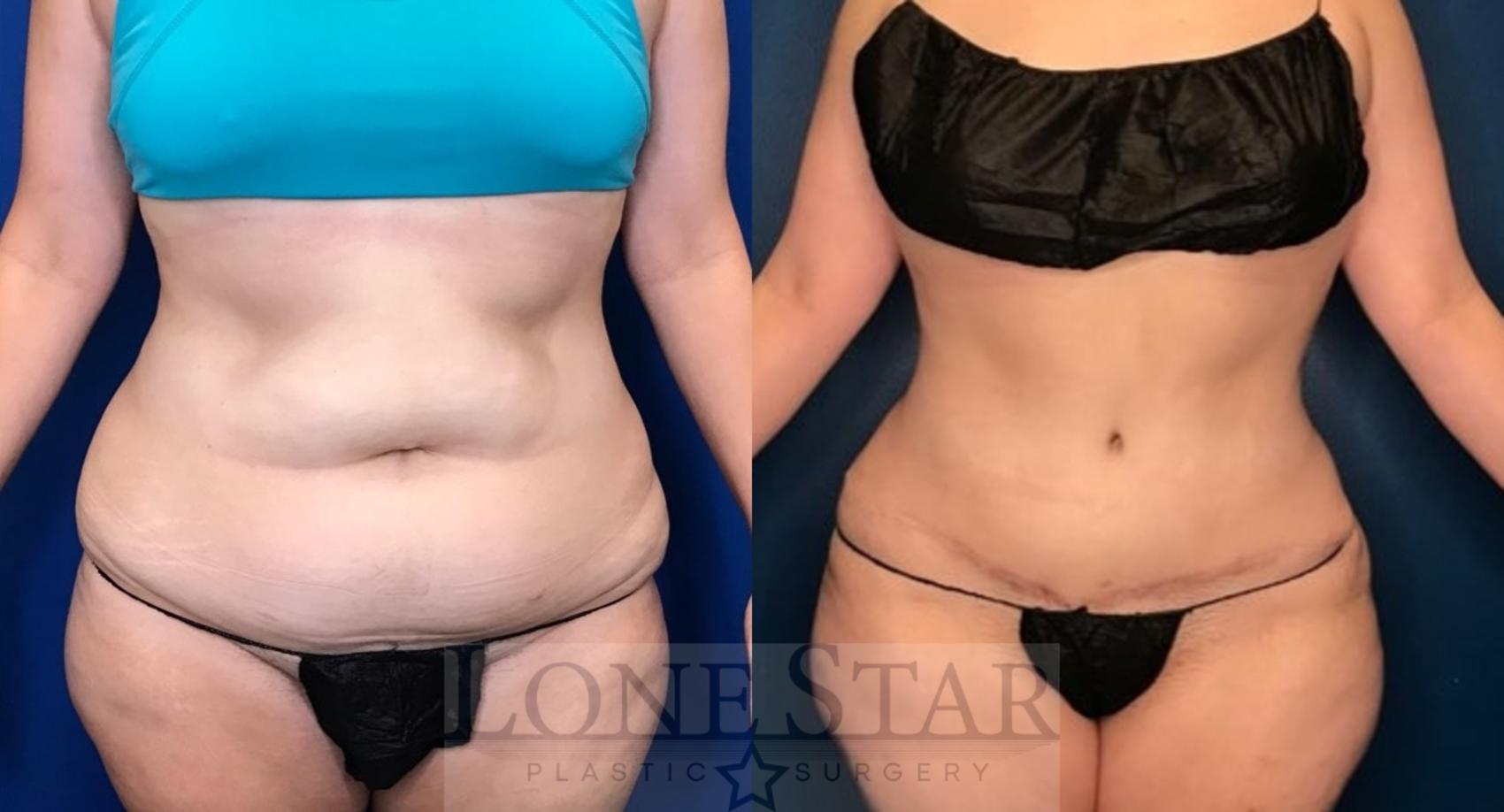 Before & After Tummy Tuck Case 105 Front View in Frisco, TX