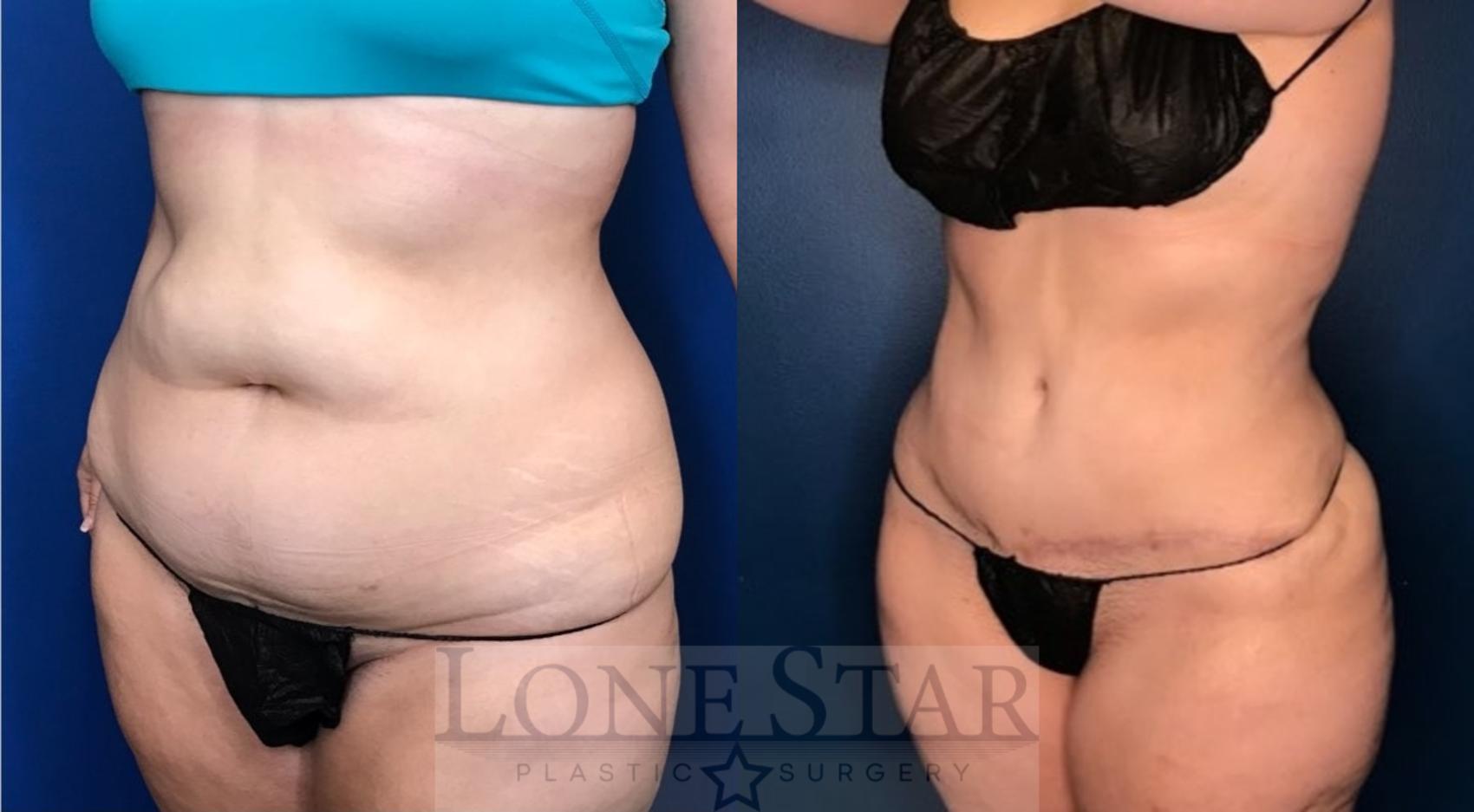 Before & After Tummy Tuck Case 105 Left Oblique View in Frisco, TX