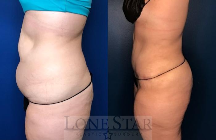 Before & After Tummy Tuck Case 105 Left Side View in Frisco, TX