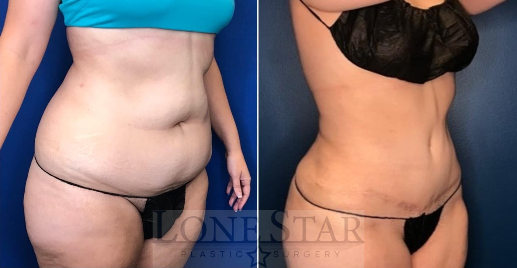 Before & After Tummy Tuck Case 105 Right Oblique View in Frisco, TX