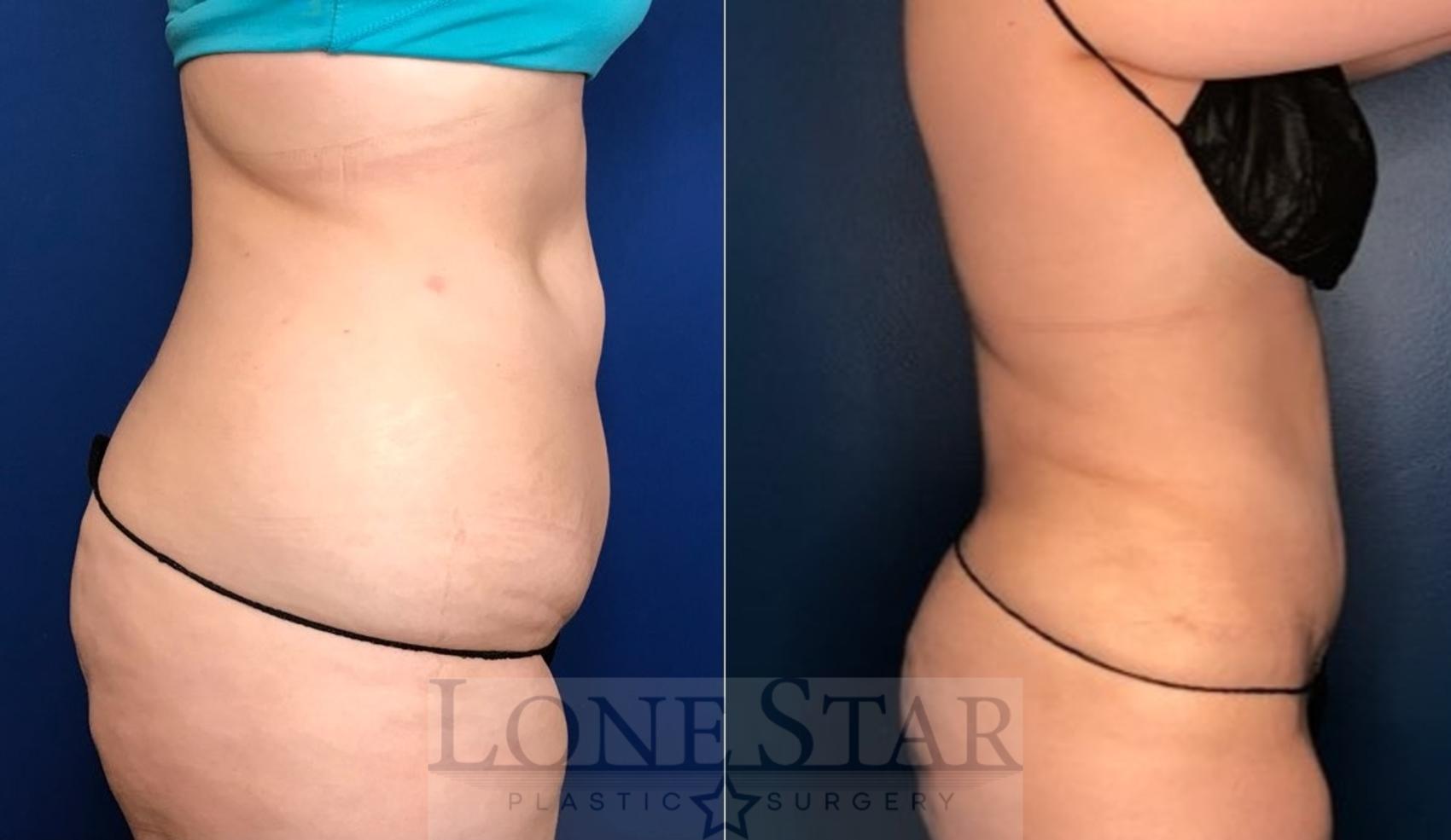 Before & After Tummy Tuck Case 105 Right Side View in Frisco, TX