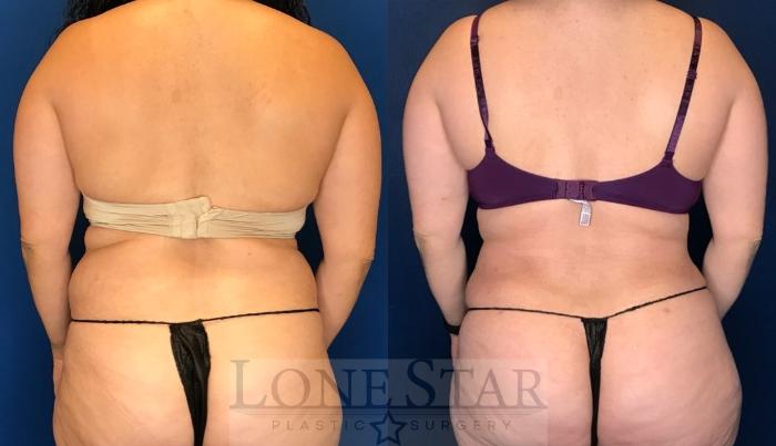 Before & After Tummy Tuck Case 107 Back View in Frisco, TX