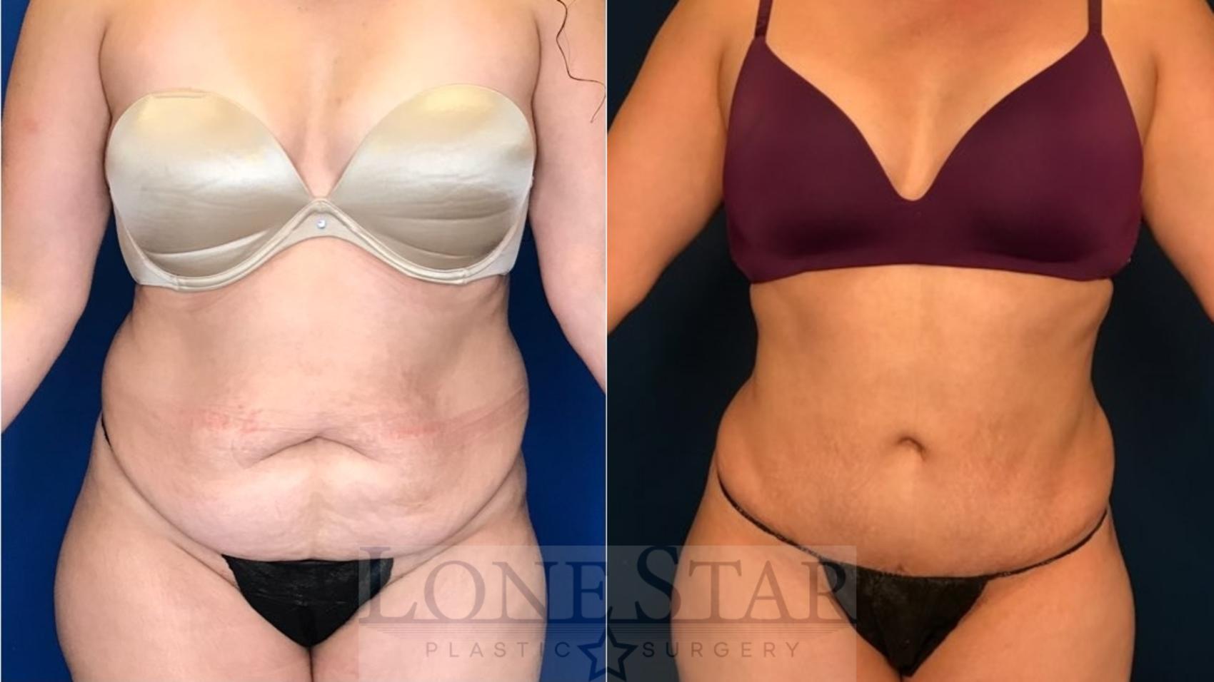 Before & After Tummy Tuck Case 107 Front View in Frisco, TX