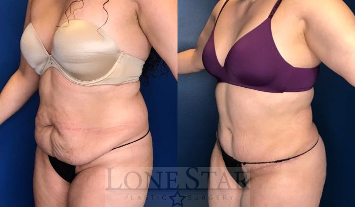 Before & After Tummy Tuck Case 107 Left Oblique View in Frisco, TX