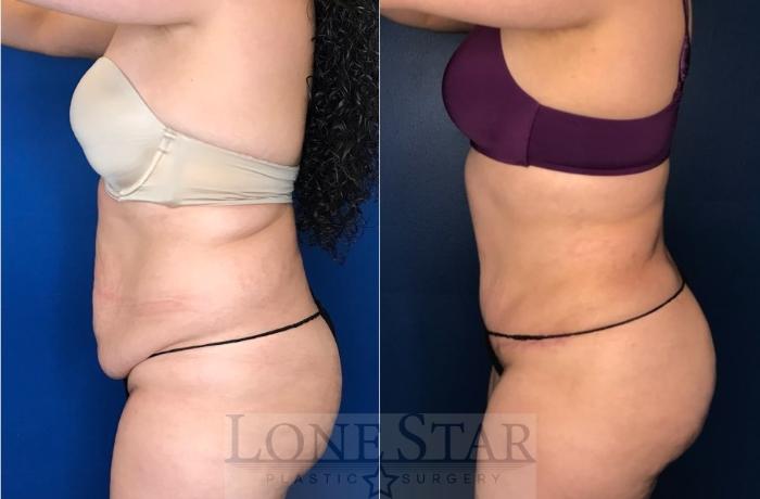 Before & After Tummy Tuck Case 107 Left Side View in Frisco, TX