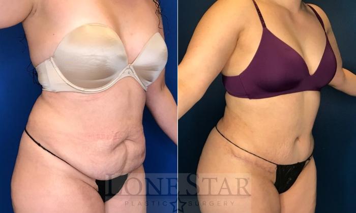 Before & After Tummy Tuck Case 107 Right Oblique View in Frisco, TX