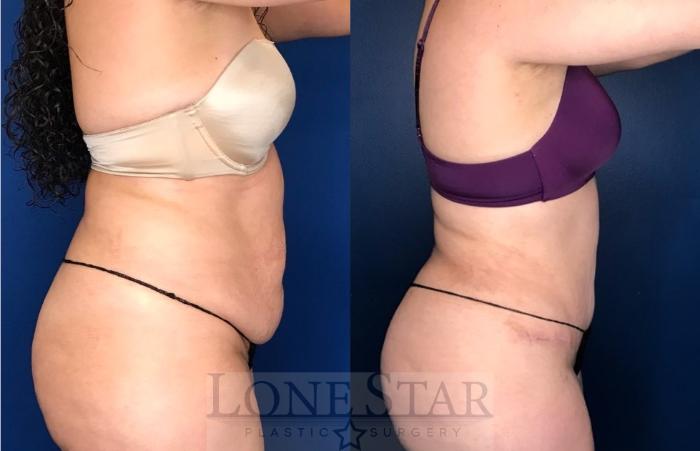 Before & After Tummy Tuck Case 107 Right Side View in Frisco, TX