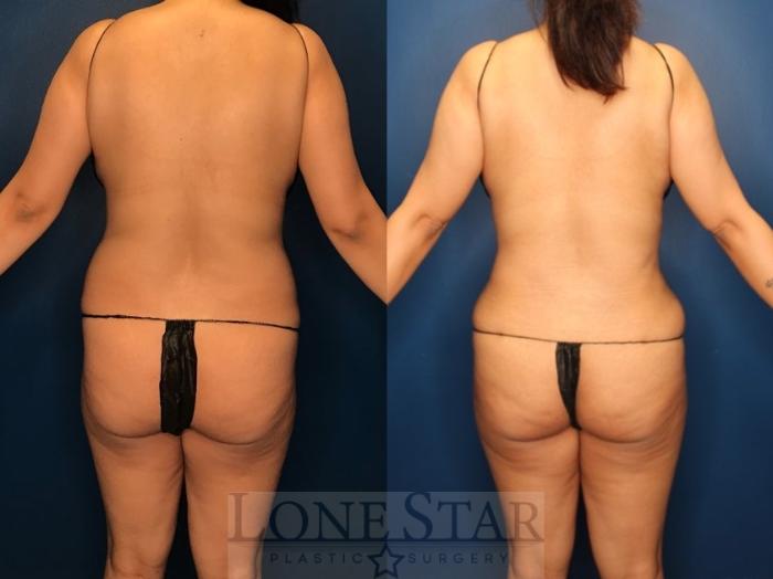 Before & After Tummy Tuck Case 127 Back View in Frisco, TX