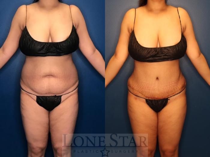 Before & After Tummy Tuck Case 127 Front View in Frisco, TX