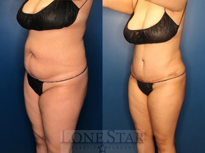 Before & After Tummy Tuck Case 127 Left Oblique View in Frisco, TX
