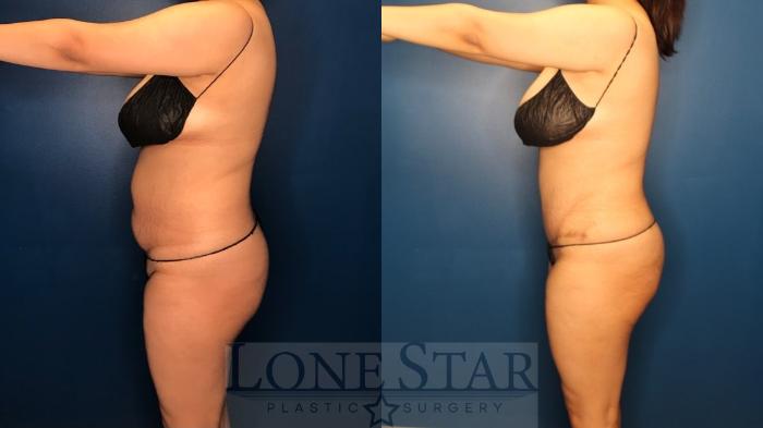 Before & After Tummy Tuck Case 127 Left Side View in Frisco, TX