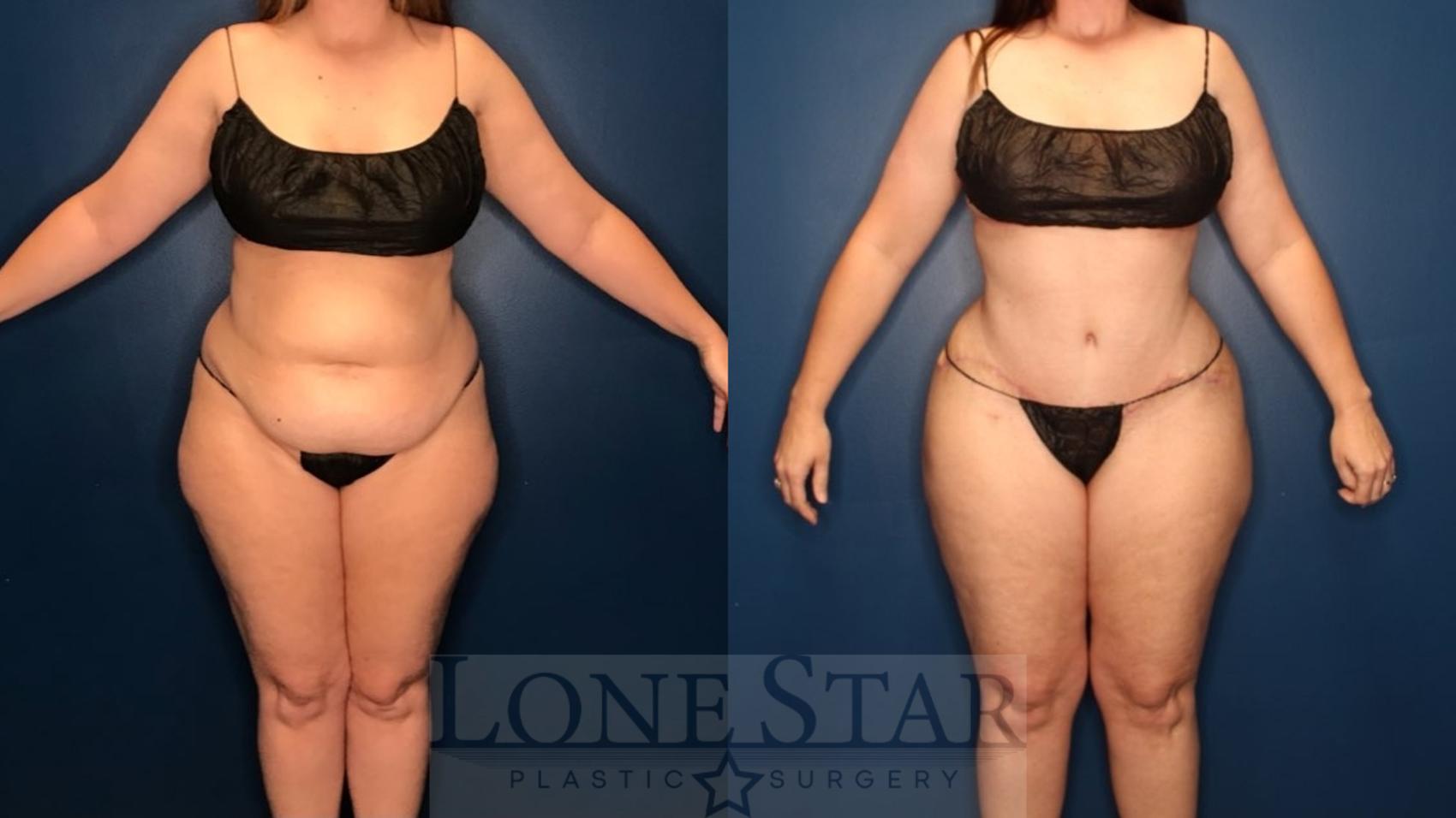Before & After Tummy Tuck Case 131 Front View in Frisco, TX