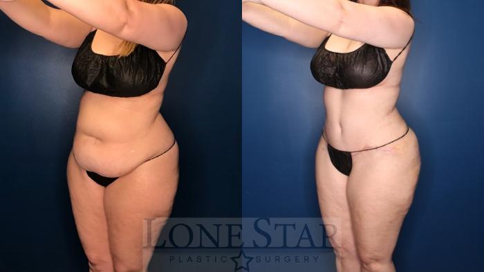 Before & After Tummy Tuck Case 131 Left Oblique View in Frisco, TX