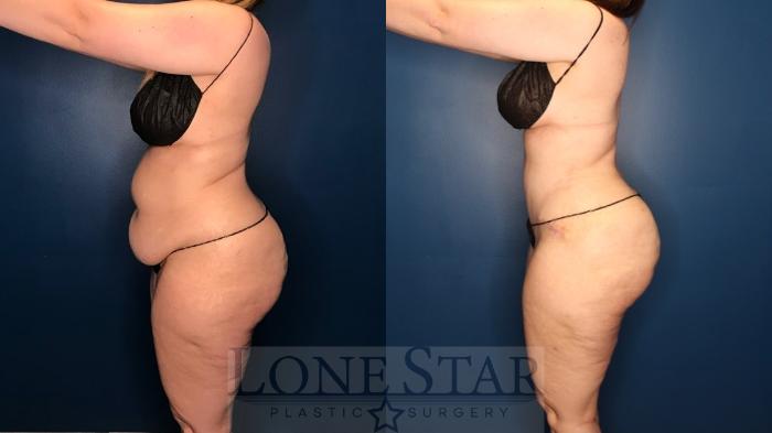 Before & After Tummy Tuck Case 131 Left Side View in Frisco, TX