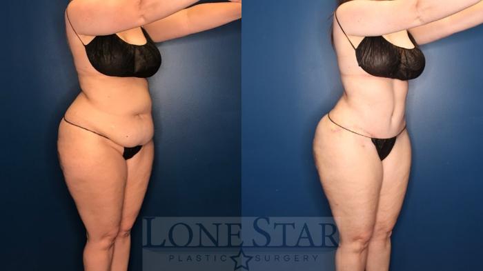 Before & After Tummy Tuck Case 131 Right Oblique View in Frisco, TX