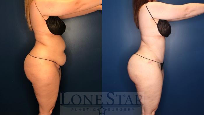 Before & After Tummy Tuck Case 131 Right Side View in Frisco, TX